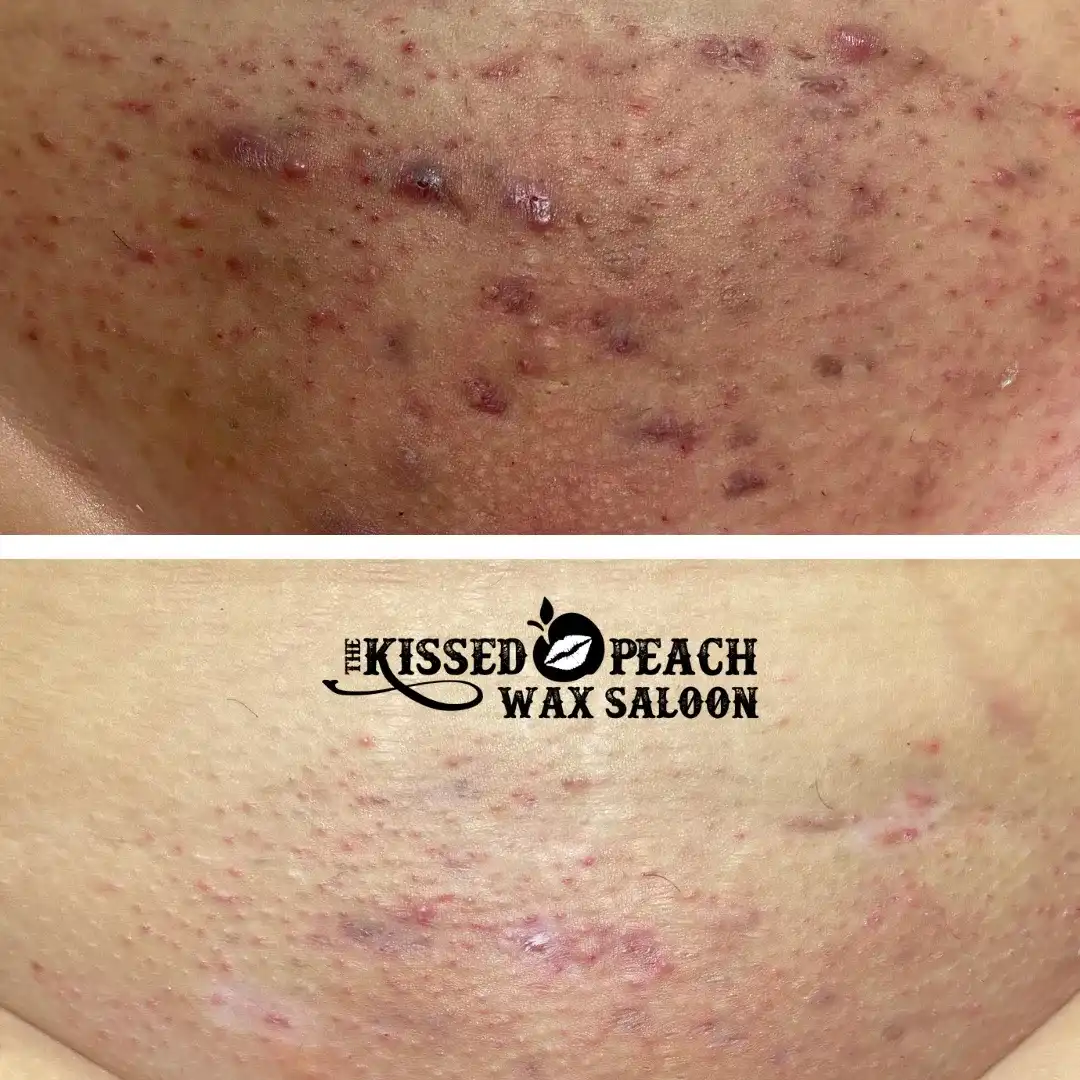 Pubic Mound Before and After at Kissed Peach